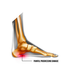 Foot Pain Plantar Fasciitis Inflammation