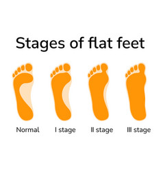 Stages Of Flat Feet