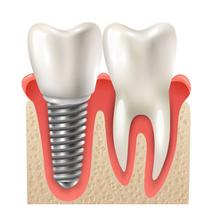 Dental Implant Tooth Set Closeup Model