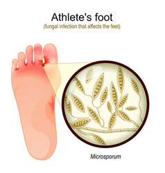 Athletes Foot Fungal Infection That Affects