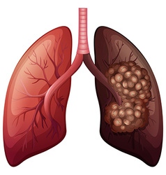 Normal Lung And Lung Cancer