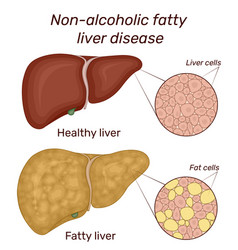 Non-alcoholic Fatty Liver Disease