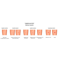 Evaluation Of Mantoux Test Response