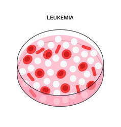 Leukemia Cancer Disease