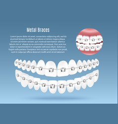 Metal Dental Teeth Braces Banner Mockup Realistic