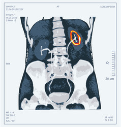 X-ray Of Human Abdomen With Pelvic Bone And Spine