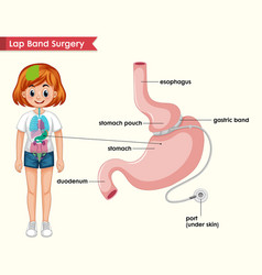 Scientific Medical Lap Band Process