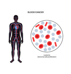 Leukemia Cancer Disease