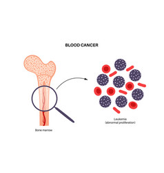 Leukemia Cancer Disease