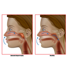 Adenoid Hypertrophy Abnormal Growth