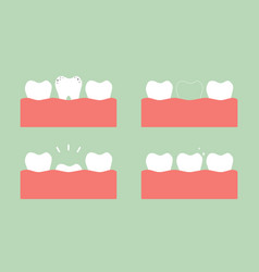 Step Of Caries To First Teeth