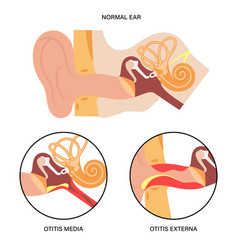 Externa Media Otitis