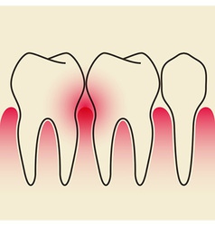 Periodontal Disease