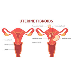 Woman Uterine Fibroids Diagram On White Background