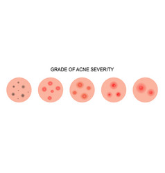 Grade Of Acne Severity Medical Diagram Different