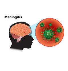 Viral Meningitis And Encephalitis