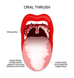 Oral Thrush A White Coating On The Tongue