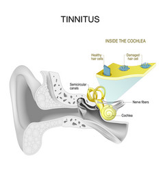 Tinnitus Human Ear