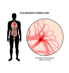 Pulmonary Embolism Disease