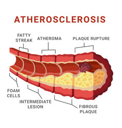 Atherosclerosis Formation Artery Cross Section