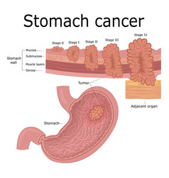 Stomach Cancer