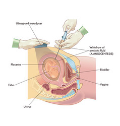 Amniocentesis