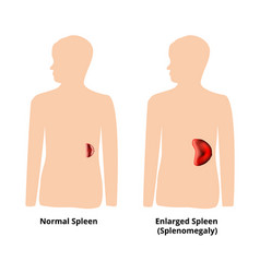 Splenomegaly Spleen Enlargement