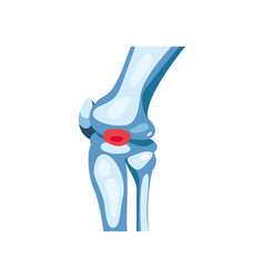 Rheumatology Knee Bones