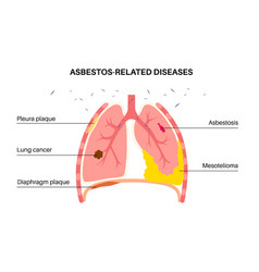 Asbestos Related Diseases