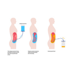 Peritoneal Dialysis Concept