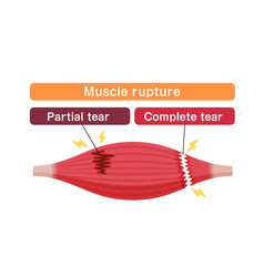 Muscle Rupture Partial And Complete Tears