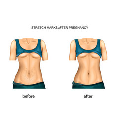 Stretch Marks After Pregnancy Before And After