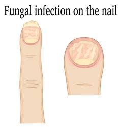 Nail Fungal Infection