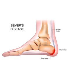 Severs Disease Calcaneus Apophysitis