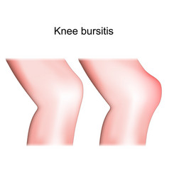 Knee Bursitis Prepatellar Bursitis