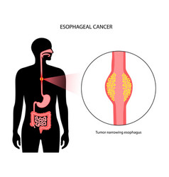 Esophageal Cancer Concept