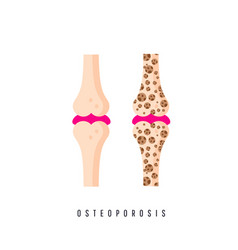 Two Bones Are Normal And Sore Osteoporosis Bone