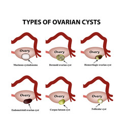 Types Of Ovarian Cysts Set Infographics