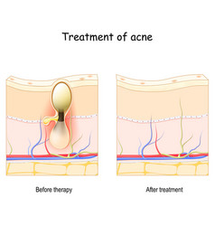 Acne Treatment Cross Section Of The Skin