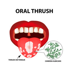 Oral Thrush Candidiasis On The Tongue Fungus