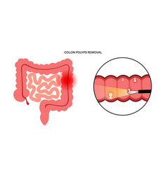 Colon Polyps Inflammation