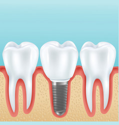 Dental Implant Realistic