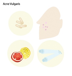 Acne Vulgaris And Take Care Facial Skin