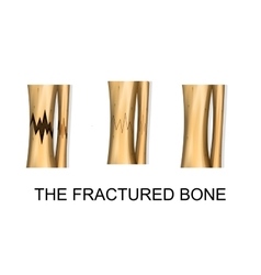 Bone Fracture Trauma