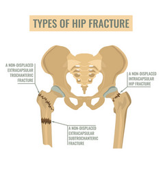 Types Of Hip Fracture