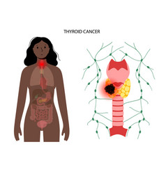 Thyroid Cancer Stages