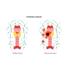 Thyroid Cancer Stages