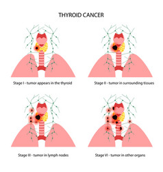 Thyroid Cancer Stages