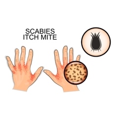 Infection Of Scabies Itch Mite