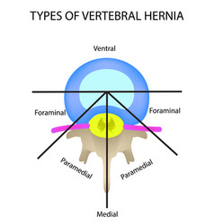 Types Of Location Of The Intervertebral Hernia